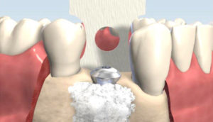 Bone Grafting Surgery