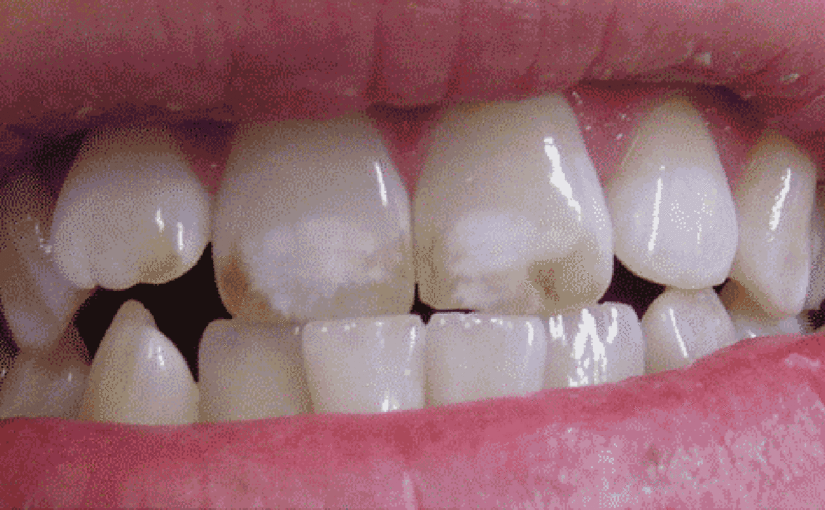 Dental Fluorosis Symptoms, Causes and Treatment » Locus Dental Care